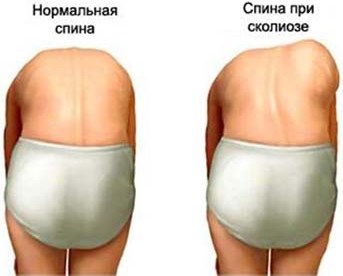Искривление спины