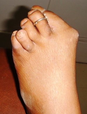 hallux valgus