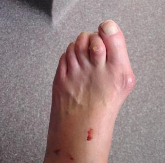 Hallux valgus