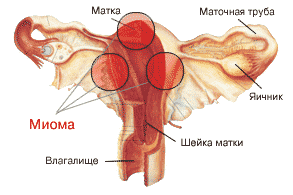 Доброкачественная опухоль матки