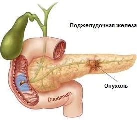 Опухоль поджелудки